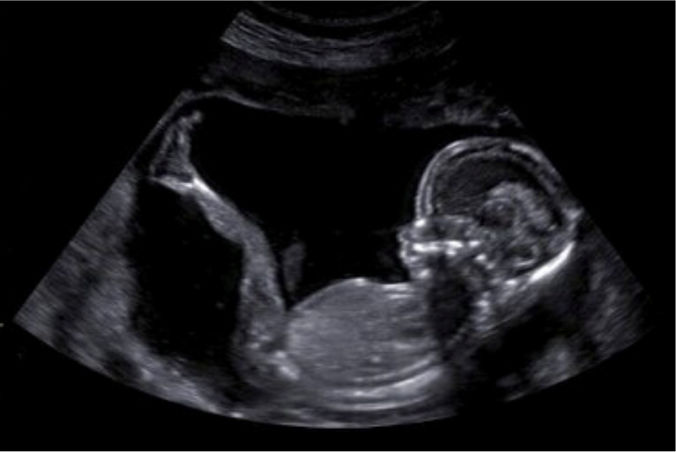 Reassurance Ultrasound
