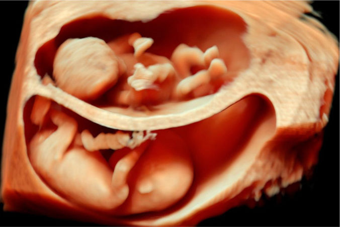 Twins/Multiple Pregnancy